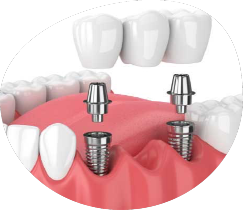 implantes dentales en Triana